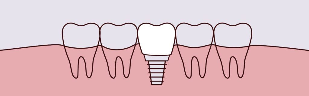dental implants oral surgery NJ