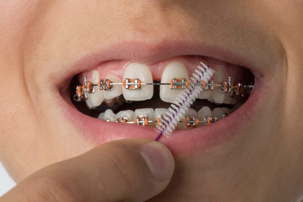 braces aftercare