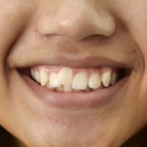 Crooked teeth smile repair