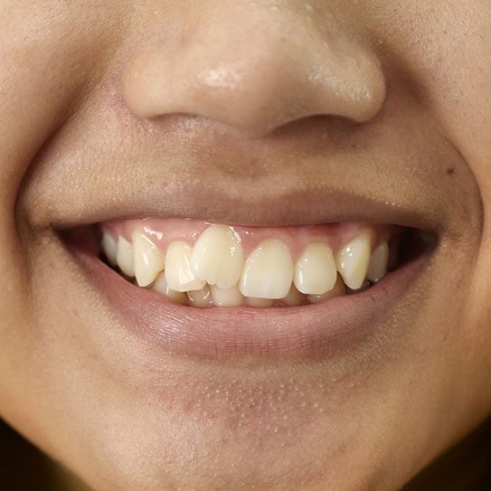 Crooked teeth smile repair