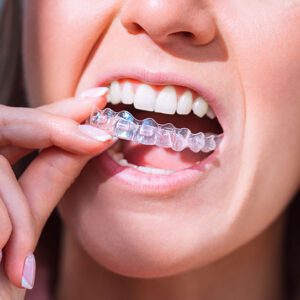 invisalign
