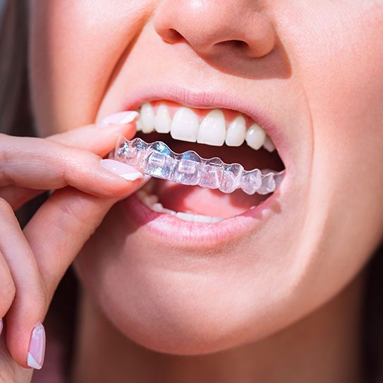 invisalign