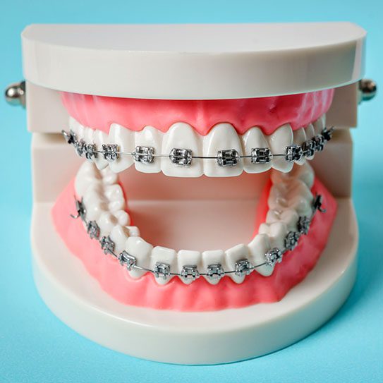 metal braces