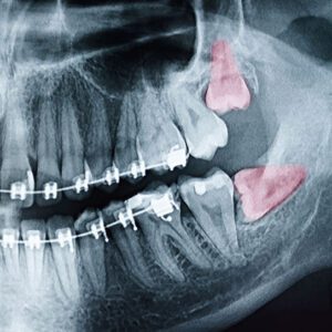 oral surgery wisdom teeth removal