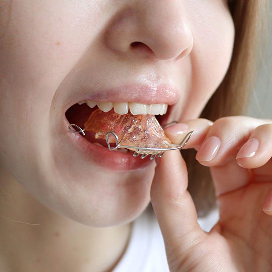 orthodontist retainers