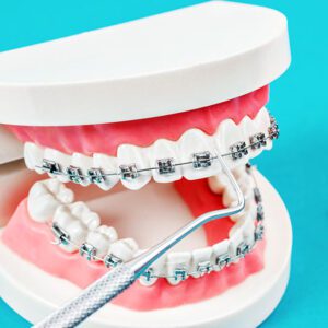 affordable braces near me
