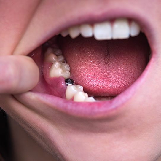 dental implants