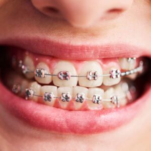 braces West New York orthodontist Invisalign