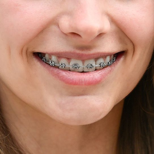 braces deptford invisalign deptford orthodontist deptford