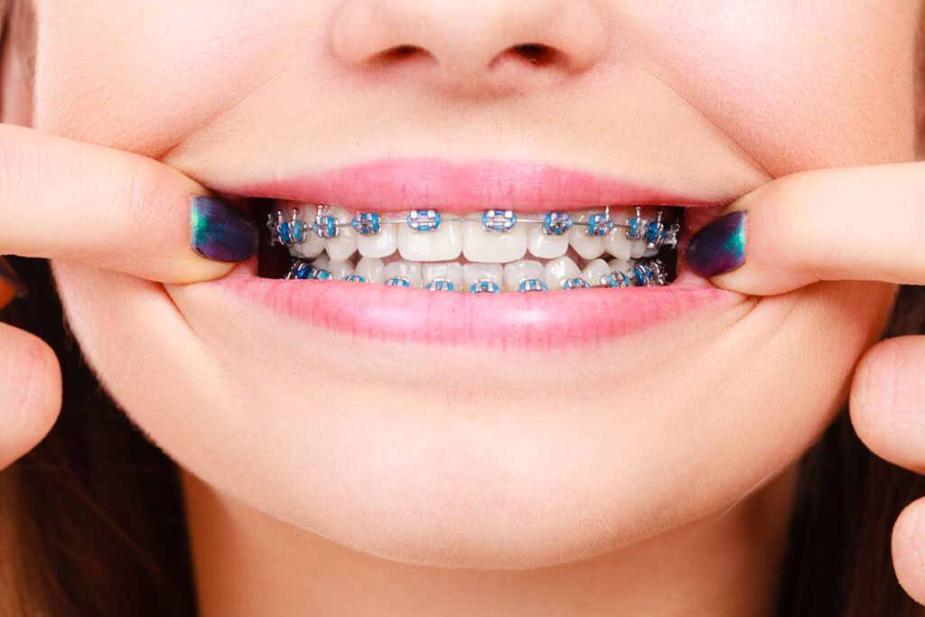 braces invisalign orthodontist Paterson nj