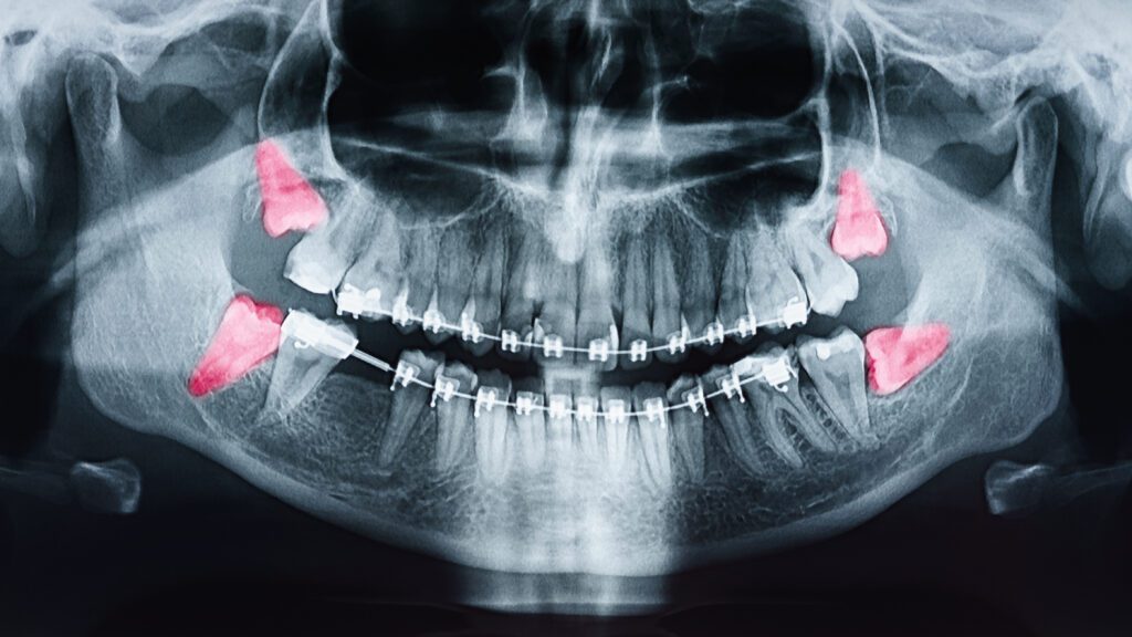 When the Orthodontist in West Orange Recommends Wisdom Teeth Removal - MyOrthodontist - orthodontist in West Orange wisdom teeth removal orthodontics
