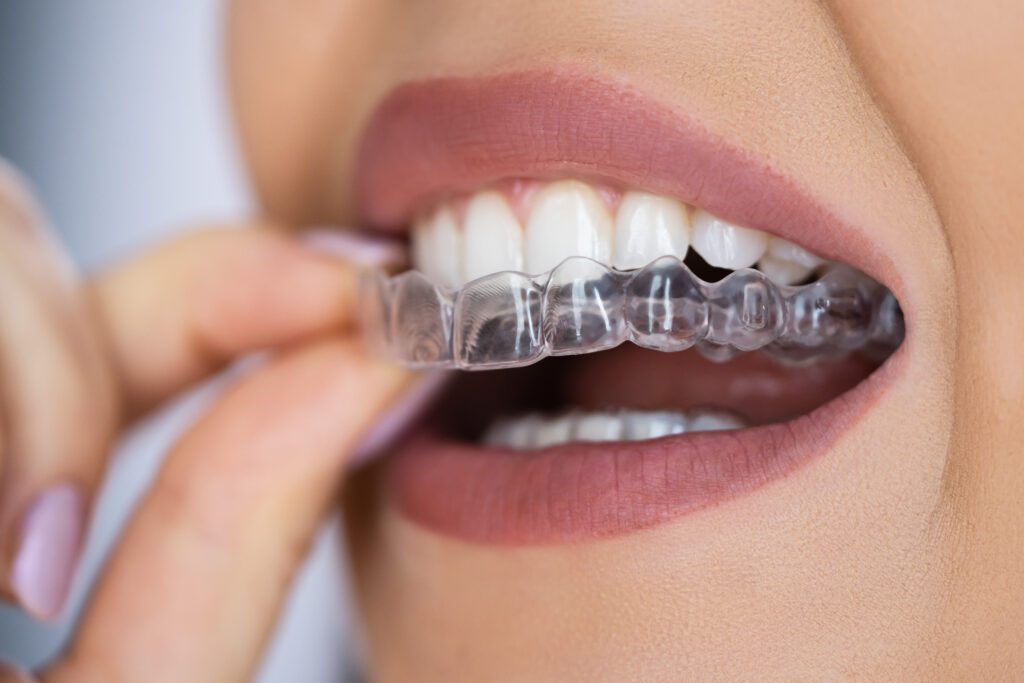 New Year's Resolution: Find Clear Aligners Near Me - MyOrthodontist - clear aligners near me affordable Invisalign orthodontist in Paterson