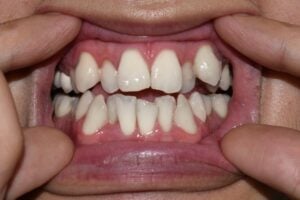 crowded teeth gaps in teeth