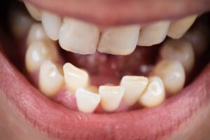 affordable orthodontist near me crooked teeth