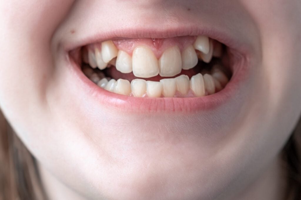 Why Do Crowded Teeth Increase Cavity Risk? - MyOrthodontist - crowded teeth crowded teeth