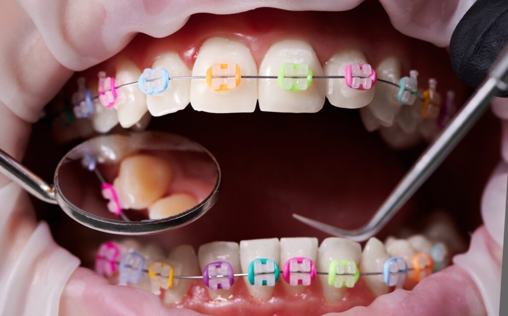What Are the Signs My Child May Need Braces? - MyOrthodontist - Braces in West Orange