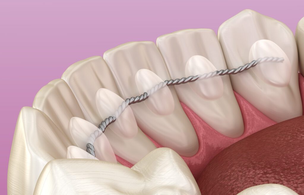 Can Orthodontic Treatment Improve Gum Health? - MyOrthodontist - orthodontic treatment in West New York