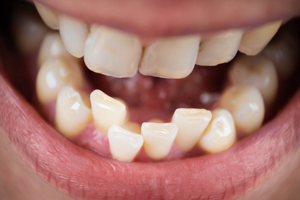 Why Does Lower Teeth Crowding Keep Happening, Even After Braces? - MyOrthodontist - lower teeth crowding lower teeth crowding