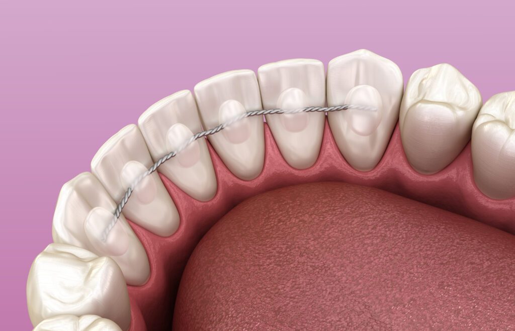 Why Doesn't My Retainer Fit Anymore? Expert Tips - MyOrthodontist - retainer Retention in West New York