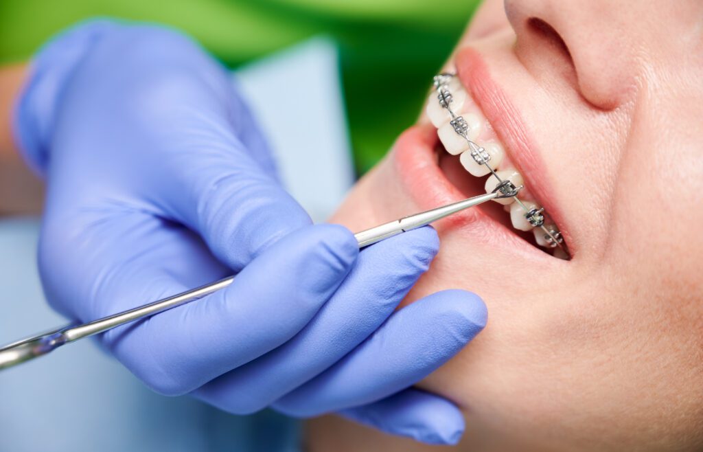 When Should You See a West Orange Orthodontist, and Why Do Some Teeth Erupt Crooked? - MyOrthodontist - West Orange orthodontist