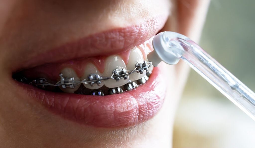 Before Getting Braces, Why Do Some Patients Need Teeth Removed? - MyOrthodontist - braces in Cherry Hill