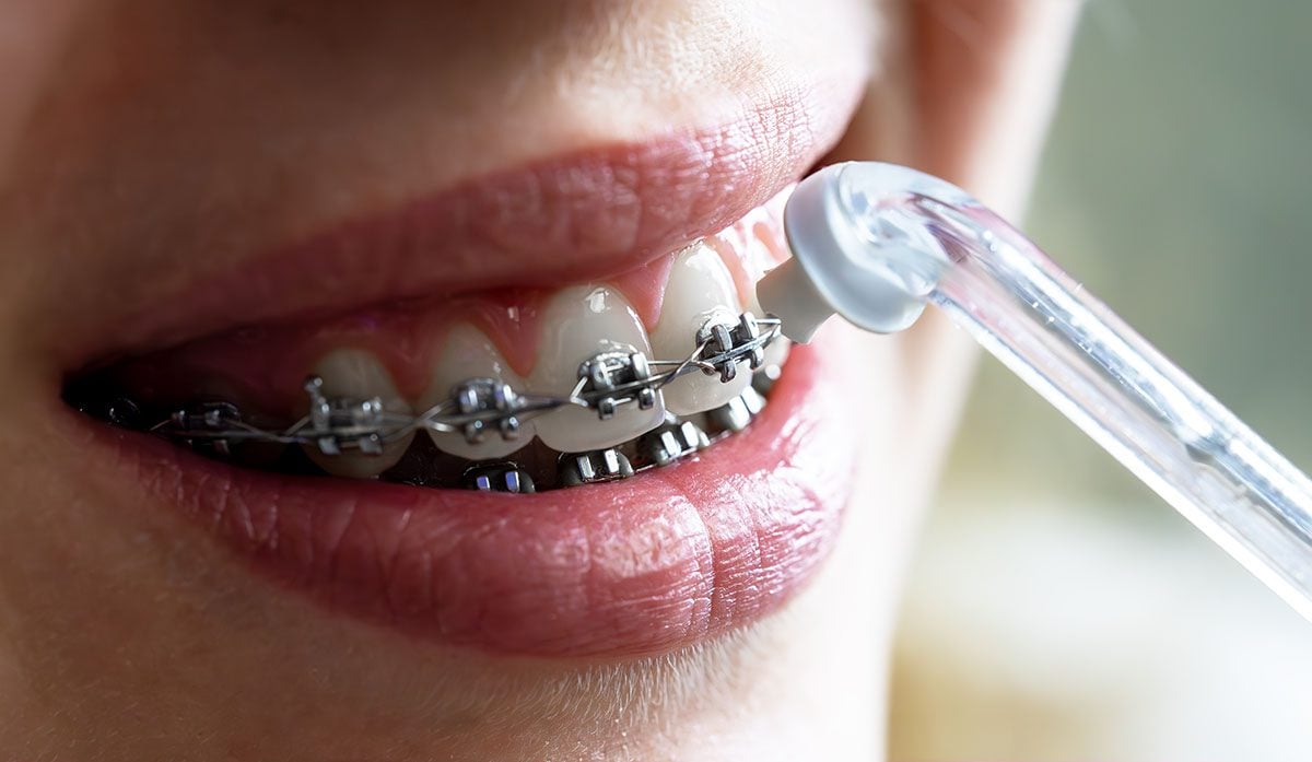 Before Getting Braces, Why Do Some Patients Need Teeth Removed? - MyOrthodontist - braces braces in Cherry Hill